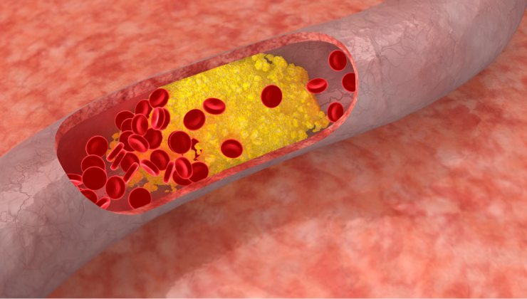 Colesterolo, il nuovo farmaco che aiuta ad abbassarlo: ecco come lo fa