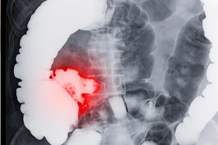 Cancro al colon: le cause